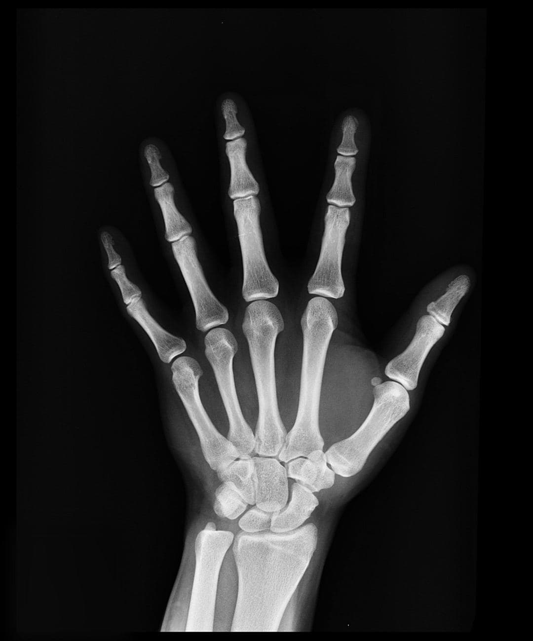Scaphoid Fracture: Symptoms, Diagnosis and Treatment
